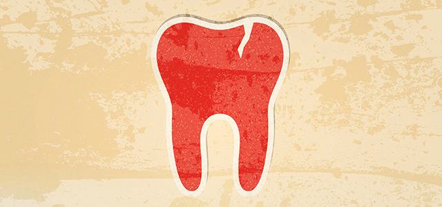 Cracked Teeth Causes Symptoms and Treatment